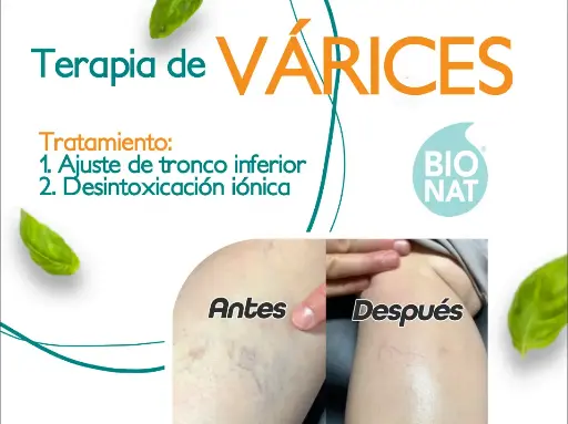 Terapia para Várices